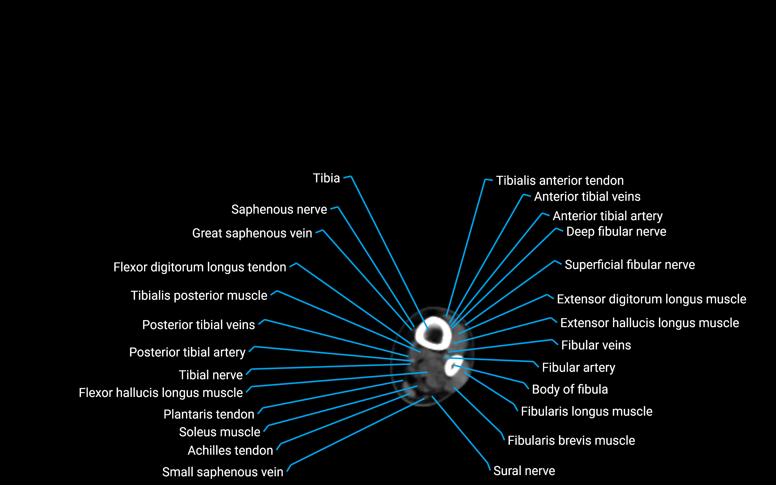 CT Lower leg axial cross sectional anatomy labelled image 154 (2).png
